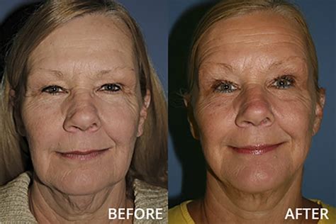 st louis facial plastic surgery